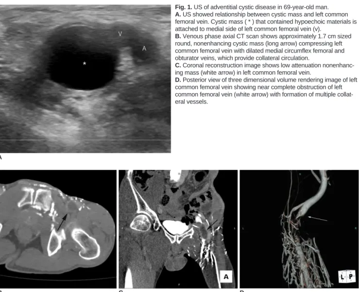 Fig. 1. US of adventitial cystic disease in 69-year-old man.