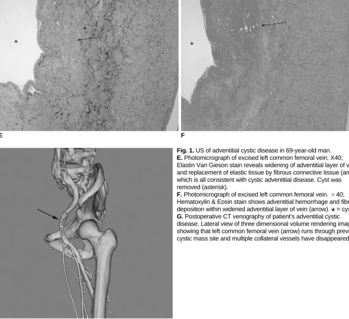 Fig. 1. US of adventitial cystic disease in 69-year-old man.