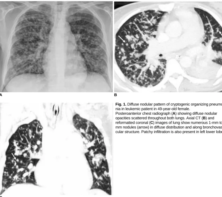 Fig. 1. Diffuse nodular pattern of cryptogenic organizing pneumo- pneumo-nia in leukemic patient in 49-year-old female.