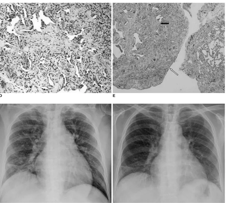 Fig. 1. Diffuse nodular pattern of cryptogenic organizing pneumonia in leukemic patient in 49-year-old female.