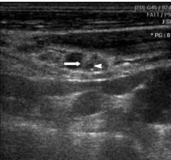 Fig. 1. 52-year-old man with recurrent papillary thyroid carcinoma.