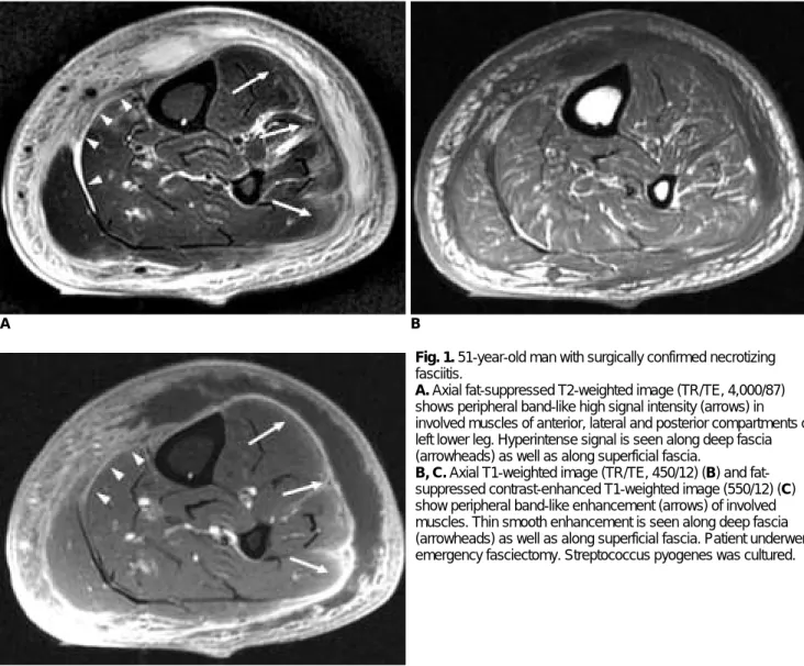 Fig. 1. 51-year-old man with surgically confirmed necrotizing fasciitis.
