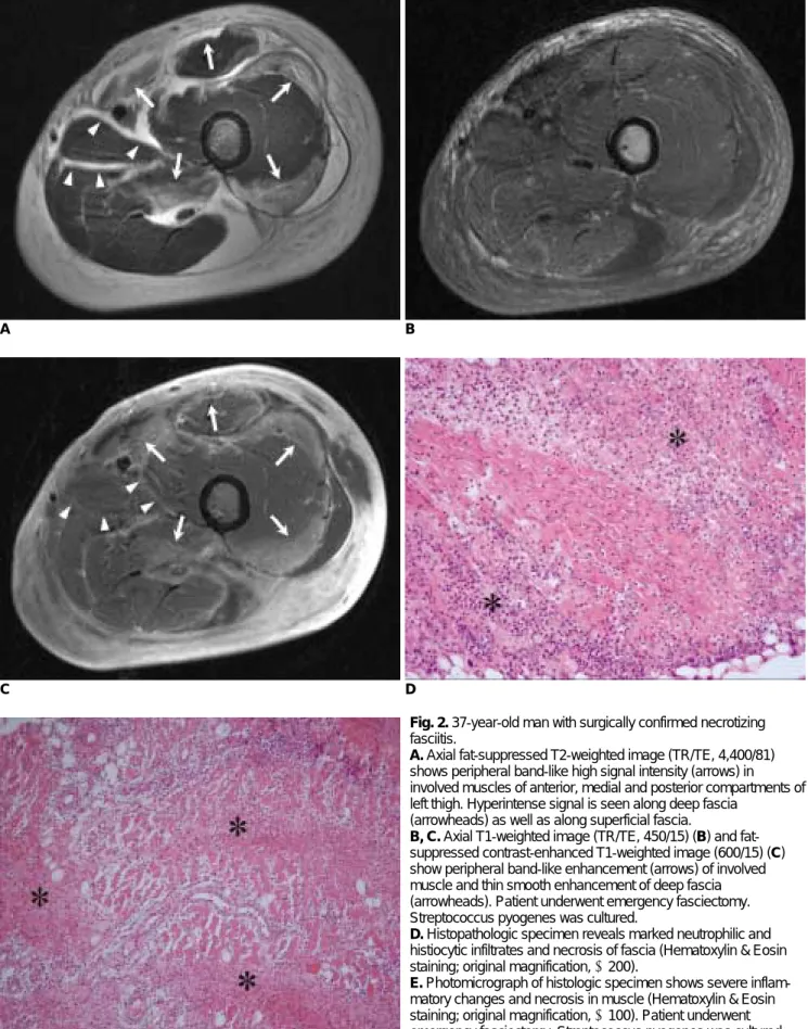 Fig. 2. 37-year-old man with surgically confirmed necrotizing fasciitis. 