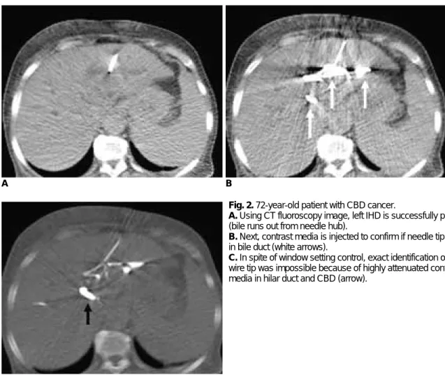 Fig. 2. 72-year-old patient with CBD cancer. 