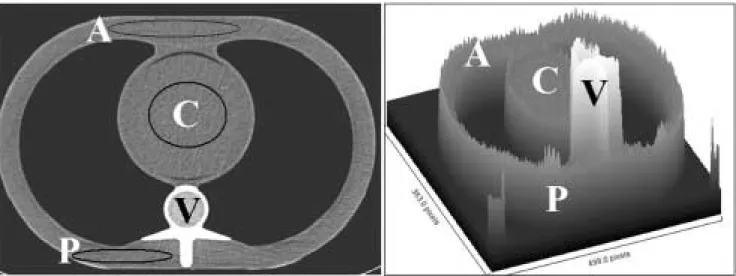 Fig. 1. Transverse CT image and surface plot of phantom without shield. Three regions of interest were drawn on CT images at same level and position in anterior (A), central (C) and posterior (P) regions of phantom