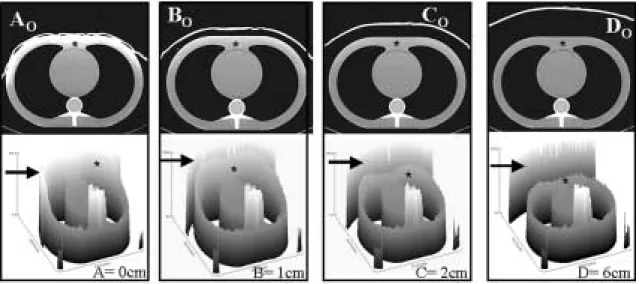 Table 1. Effect of Shield Offset Distance on Radiation Dose (mGy) Noted at Four (doses 1, 2, 3 and 4) Points on Anterior Surface of Phantom