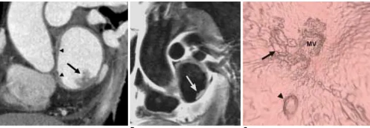 Fig. 11. Left atrial myxosarcoma in 72-year-old female.