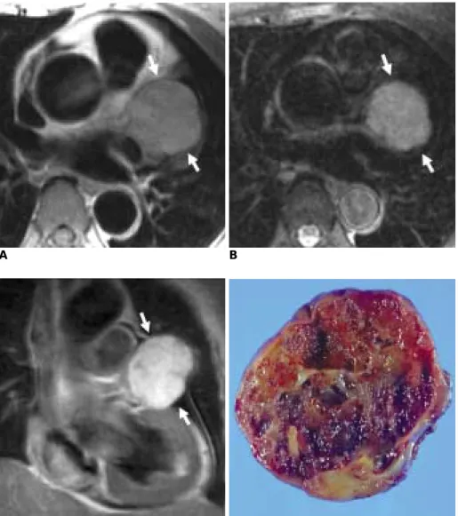 Fig. 8. Cavernous hemangioma of left atrial appendage in 66-year-old female.