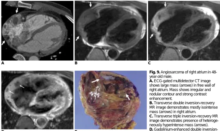 Fig. 9. Angiosarcoma of right atrium in 48- 48-year-old male.