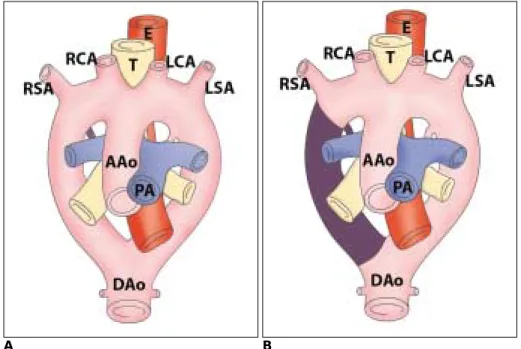 Fig. 2. Diagram of development of left aortic arch with aberrant right subclavian artery is presented