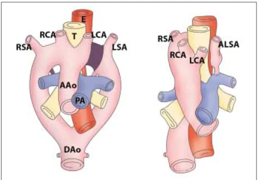 Fig. 8. Diagram of development of right aortic arch with aberrant left subclavian artery is shown