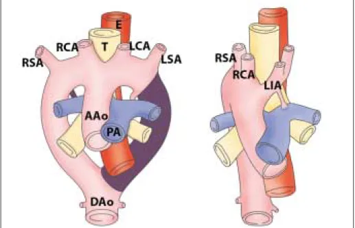 Fig. 12. Diagram of development of right aortic arch with mirror image branching.