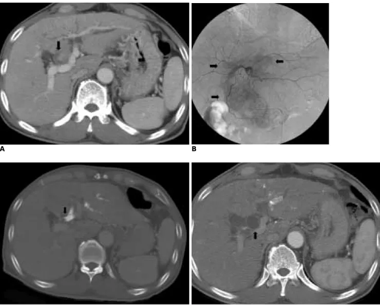 Fig. 1. Acute obstructive cholangitis after transarterial chemoembolization in 62-year-old male.
