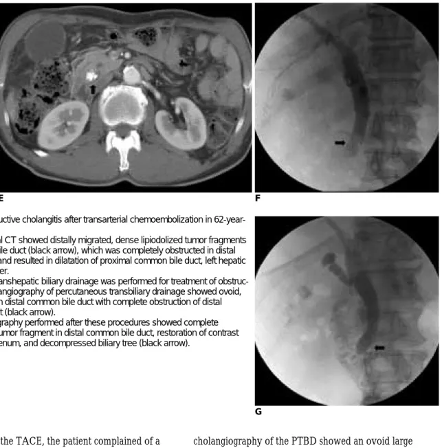 Fig. 1. Acute obstructive cholangitis after transarterial chemoembolization in 62-year- 62-year-old male.
