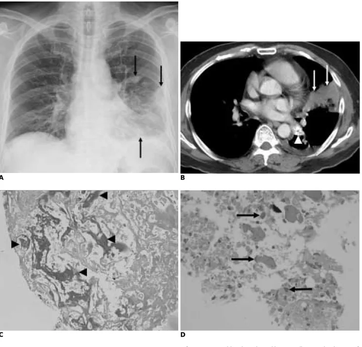 Fig. 1. 58-year-old male patient with true malignant mixed tumor of parotid gland metastasizing to lung