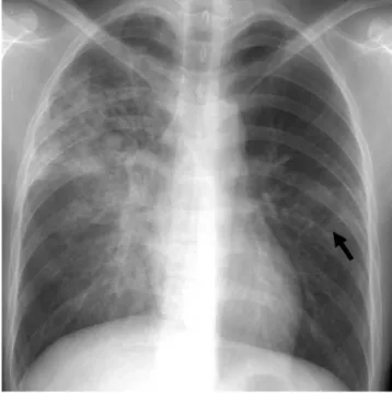 Table 3.  Extent of Parenchymal Abnormalities and Number of Cavities in Three Groups as Depicted on Chest Radiographs