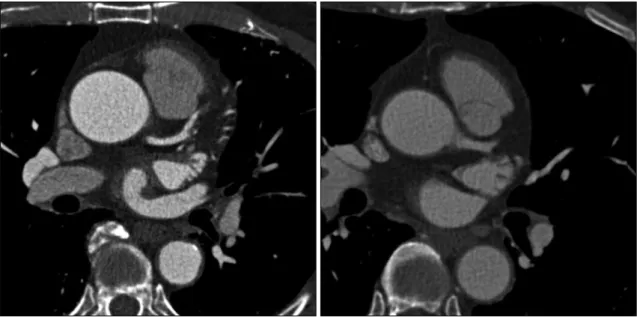 Fig. 3. Paired transverse postcontrast CT images of subjects with BMI 27.3 and window width and level of 1,200 HU and 300 HU, respectively