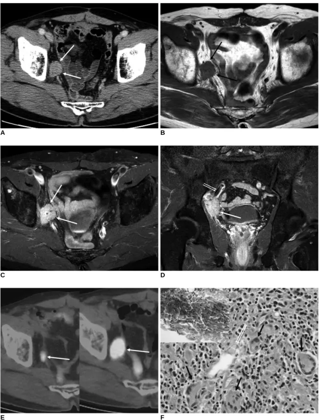 Fig. 1. 67-year-old man with suture granuloma.