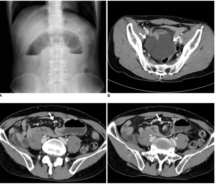 Fig. 1. 43-year old man with small bowel volvulus induced by mesenteric lymphangioma. 
