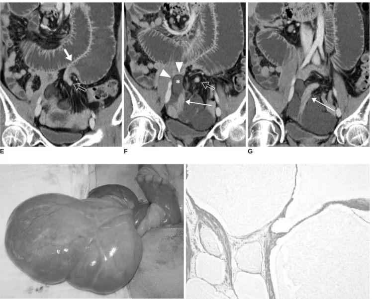 Fig. 1. 43-year old man with small bowel volvulus induced by mesenteric lymphangioma. 