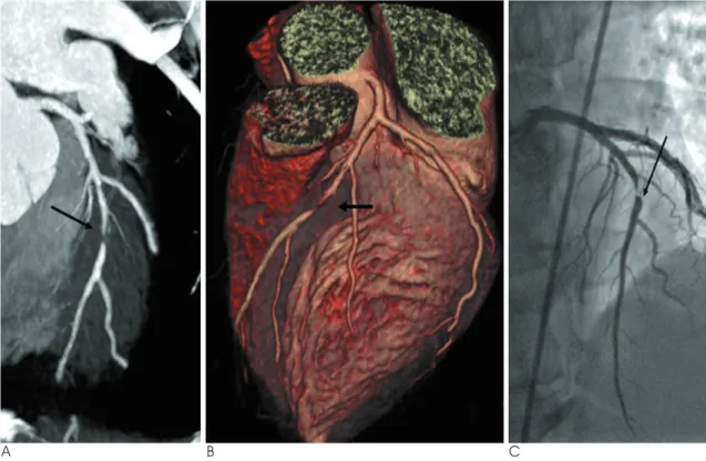 Fig. 1. Dual-source CT coronary angiography in 50-year-old man with suspected coronary artery disease (mean heart rate 88 bpm).