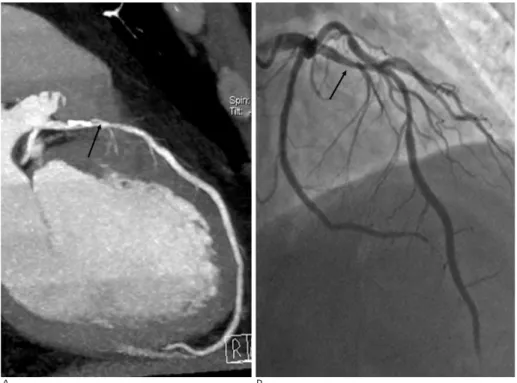 Fig. 2. Dual-source CT coronary angiog- angiog-raphy in 50-year-old man with