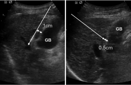 Fig. 1. Direction of electrode insertion (long arrows). It was categorized as parallel (A) or perpendicular (B)  accord-ing to direction of electrode tip for gallbladder wall
