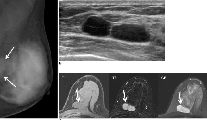 Fig. 1. Primary primitive neuroectodermal tumors in 33-year-old woman with palpable mass in left breast.
