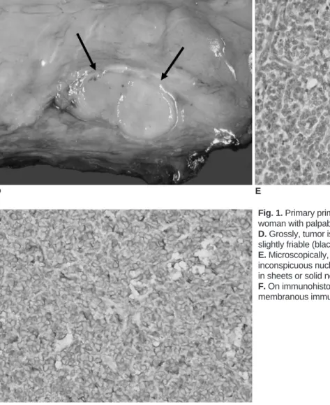 Fig. 1. Primary primitive neuroectodermal tumors in 33-year-old woman with palpable mass in left breast.