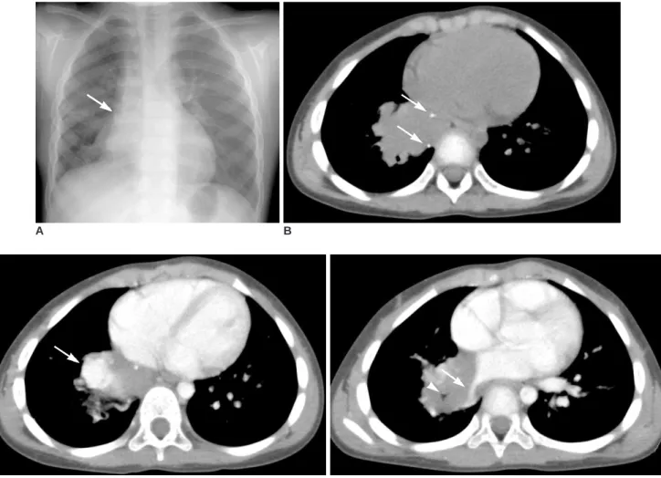 Fig. 1. 4-year-old boy with repeated episodes of pneumonia.