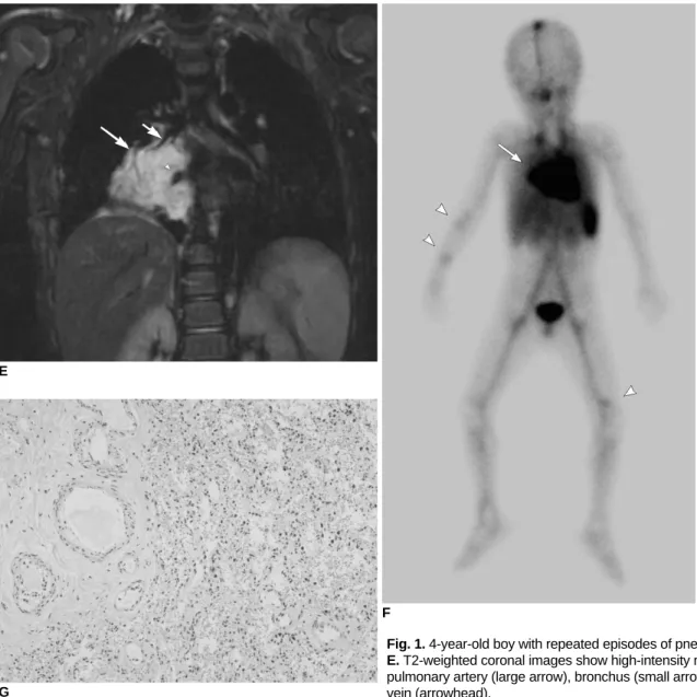 Fig. 1. 4-year-old boy with repeated episodes of pneumonia.