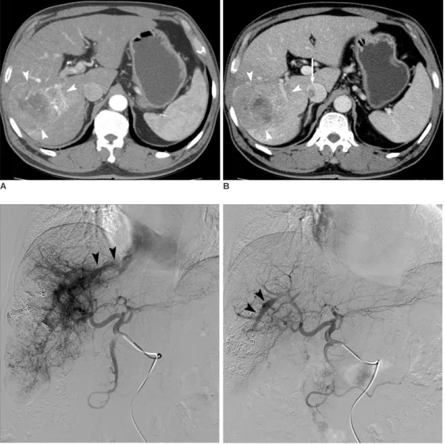 Fig. 1. 66-year-old man with hepatocellular carcinoma.