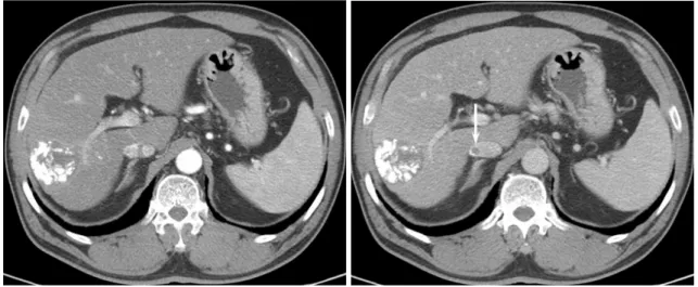 Fig. 1. 66-year-old man with hepatocellular carcinoma.