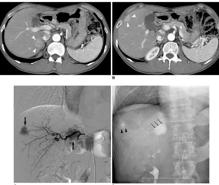 Fig. 2. 56-year-old man with hepatocellular carcinoma.