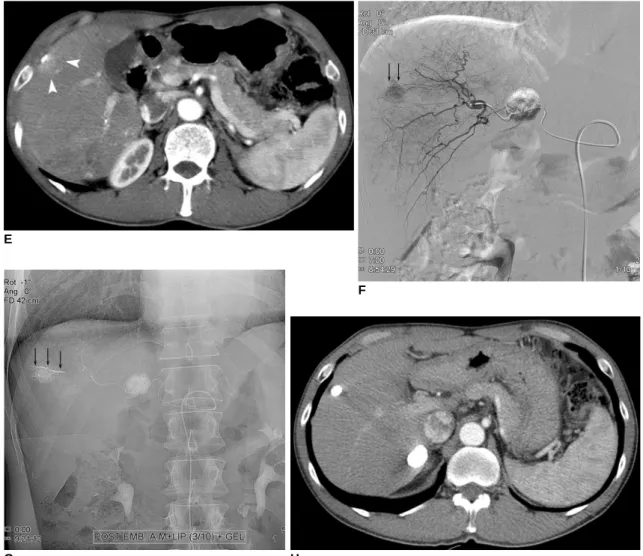 Fig. 2. 56-year-old man with hepatocellular carcinoma.