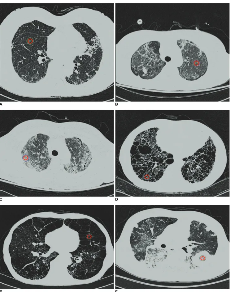 Fig. 1. High-resolution CT scans of chest (window level, -850 HU; width, 400 HU) are shown