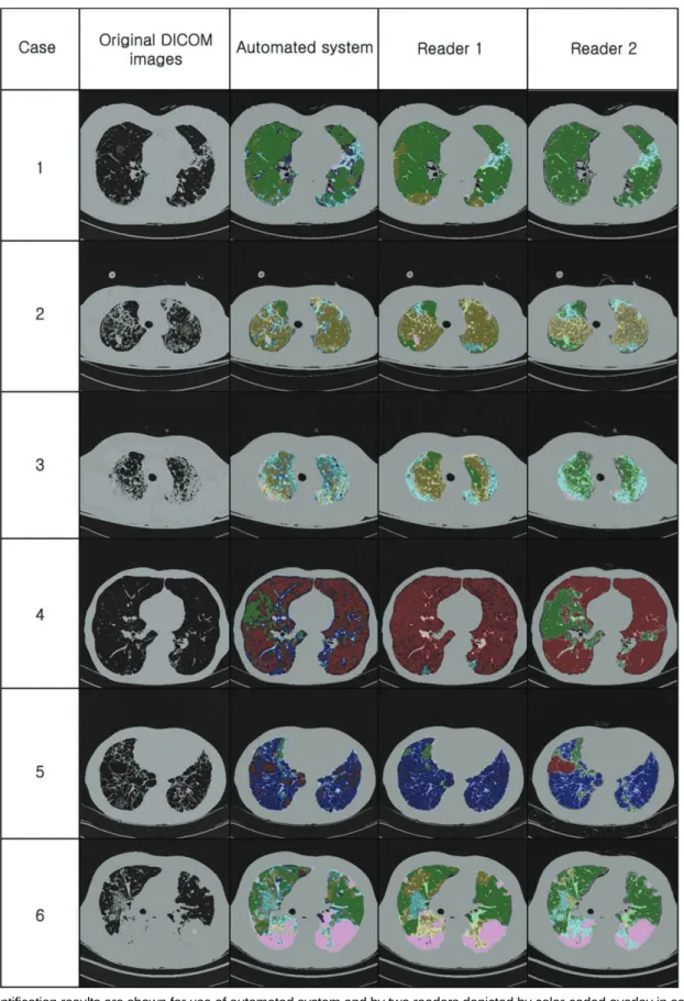 Fig. 2. Quantification results are shown for use of automated system and by two readers depicted by color-coded overlay in several cases (normal, green; ground-glass opacity, yellow; reticular opacity, cyan; honeycombing, blue; emphysema, red; consolidatio