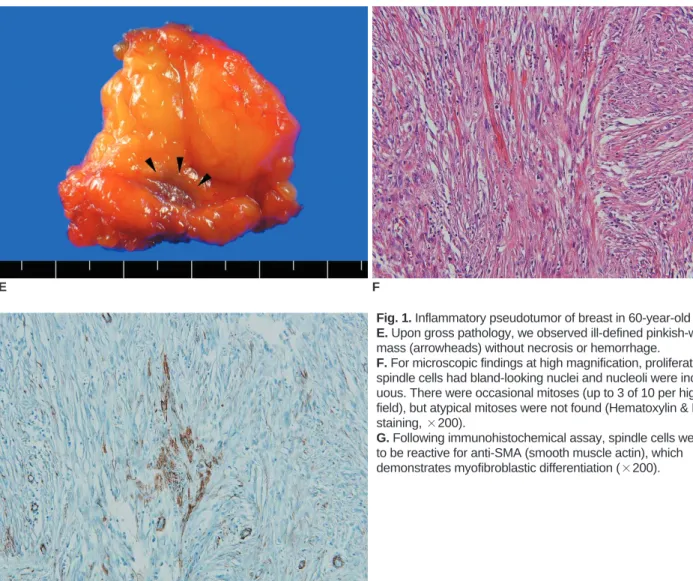 Fig. 1. Inflammatory pseudotumor of breast in 60-year-old woman.
