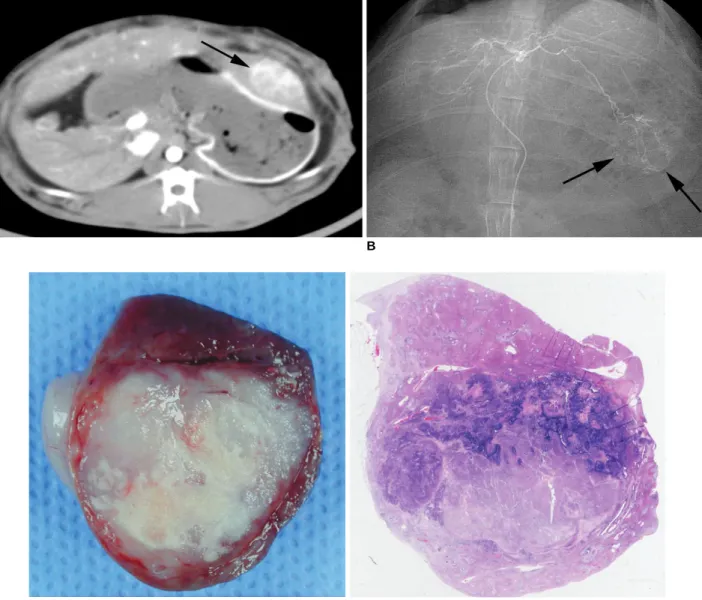 Fig. 2. Representative case of 3-BrPA 1 mM group. 