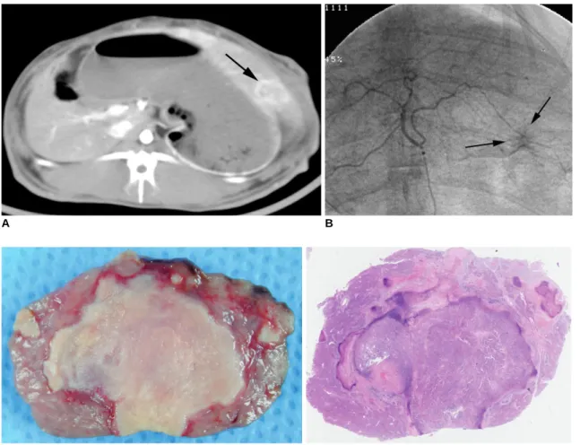 Figure 4 shows the plasma (AST) level and the plasma level (ALT) before and at 1, 2 and 7 days after intraarterial administration