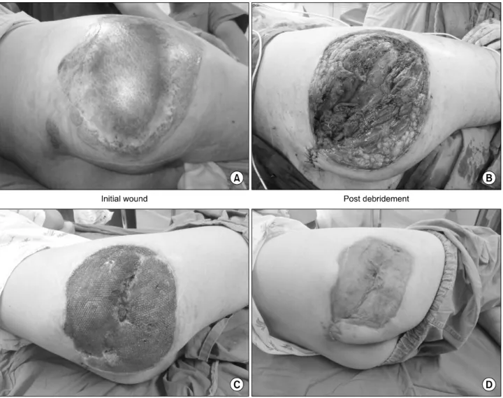 Fig. 2.  Progress  of  wound. 밀봉하는  역할을  하는  드레싱  키트  3부분으로  구성된다(Fig.  1).      음압을 발생시키는 본체는 최근 발전을 거듭하여 크기가 매우 적고 소음이 적으며,  다양한 음압모드를 적용할 수 있다