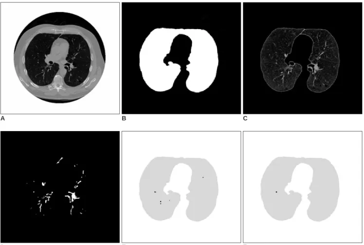 Fig. 1. Procedural flowchart for detecting lung nodules.