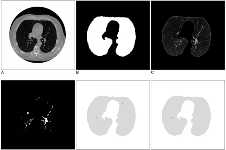 Fig. 3. A. Second CT image, B. Segmented lung region using cellular neural network, C