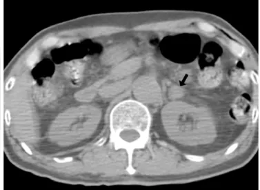 Fig. 2. A false-positive interpretation by the use of both PET and PET/CT in a 33-year-old woman with an adrenal adenoma that was confirmed by surgical excision