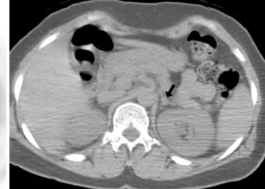 Fig. 3. A false-positive interpretation by the use of both PET and PET/CT in a 56-year-old woman with an endothelial cyst that was confirmed by surgical excision