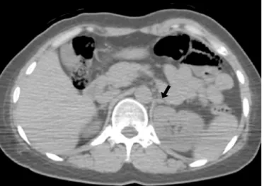 Fig. 4. A false-negative interpretation with the use of PET only, but a true positive interpretation with the use of integrated PET/CT in a 33-year-old woman with an adrenal metastasis confirmed by clinical follow-up