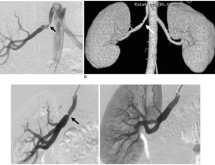 Fig. 3. A 26-year-old-man with a beaded stenosis in the midportion of the right renal artery