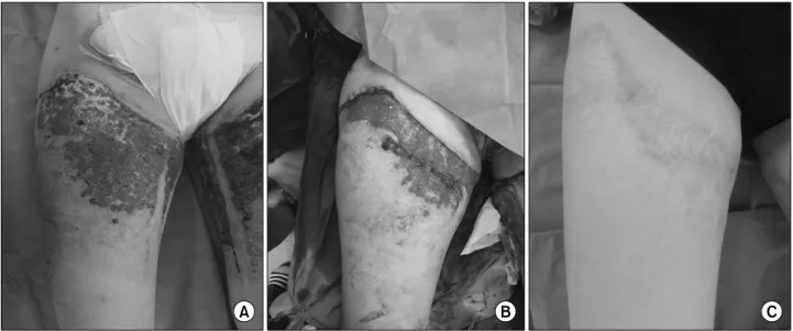 Fig. 2.  (A)  Preoperative  photo  – Thick  eschar  formation  on  her  left  buttock  area
