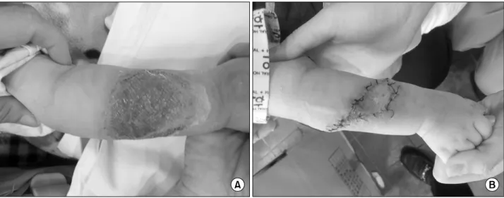 Fig. 3.  (A)  Preoperative  photo  – Conservative  treatment  was  done  during  2  weeks