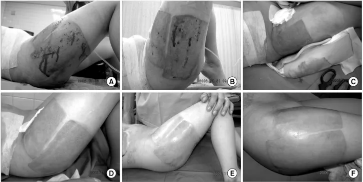 Fig. 3.  Clinical  cases  (donor  site  for  skin  graft),  flame  burn  20%  TBSA,  F/6